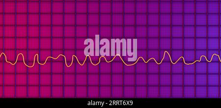 Fibrillation ventriculaire rythme cardiaque, illustration Banque D'Images