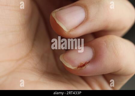 dommage à l'ongle, plaque de l'ongle, blessure sur le doigt, petit doigt. Suppuration, soin des ongles, manucure, soins médicaux. Maladies des ongles, de la peau, domestiques Banque D'Images