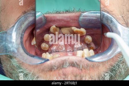 Dents pourries lors de l'inspection avec écarteur pour la conception d'implants dentaires. Banque D'Images