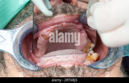 Dents pourries lors de l'inspection avec écarteur pour la conception d'implants dentaires. Banque D'Images