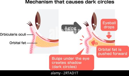 Mécanisme des cernes causés par le vieillissement. Illustration vectorielle de la coupe transversale. Illustration de Vecteur