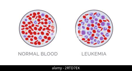 Comparaison des tests sanguins : normal et leucémie, concept de diagnostic du cancer du sang Illustration de Vecteur