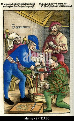 AMPUTATION MÉDIÉVALE DE JAMBE dans Feldbuch der Wundartzney publié à Strasbourg en 1517 par Hans von Gersdorff Banque D'Images