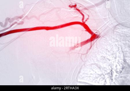 Image de l'angioplastie, de l'angioplastie par ballonnet et de l'angioplastie transluminale percutanée (PTA) . Banque D'Images