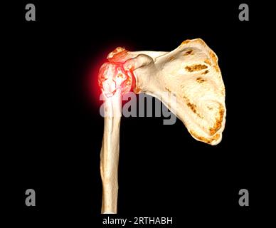 Imagerie 3D de l'articulation de l'épaule avec fracture de la tête de l'humérus. Banque D'Images