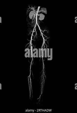 Anomalie de l'artère fémorale CTA montrant l'artère fémorale pour la maladie artérielle périphérique aiguë ou chronique diagnostique. Banque D'Images