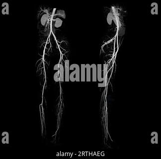 Anomalie de l'artère fémorale CTA montrant l'artère fémorale pour la maladie artérielle périphérique aiguë ou chronique diagnostique. Banque D'Images