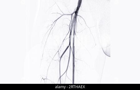 Angiographie ou angiographie de l'artère fémorale Banque D'Images