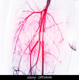 Angiographie ou angiographie de l'artère fémorale Banque D'Images