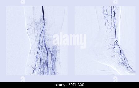 Angiorgame du pied ou angiographie plantaire montrant les artères plantaire et tarsienne au niveau du pied. Banque D'Images