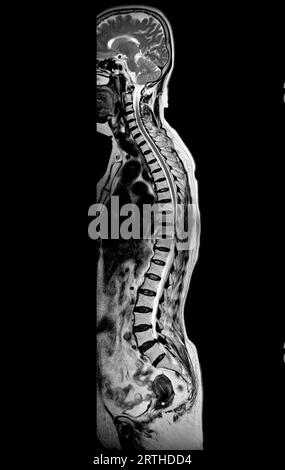 Examen IRM de la colonne vertébrale entière pour le diagnostic de la compression de la moelle épinière. Banque D'Images