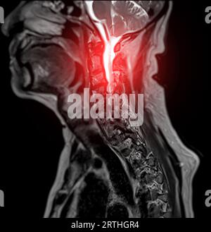 IRM du rachis cervical ou imagerie par résonance magnétique de la vue sagittale T2 FS du rachis cervical pour le diagnostic de spondylose à l'origine d'une myélopathie spondylotique cervicale A. Banque D'Images