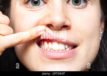 Gros plan d'une fille avec des gencives saignantes soulevant sa lèvre avec son doigt. Macro de la bouche d'une femme avec des gencives rouges. Inflammation par gingivite Banque D'Images