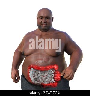 Syndrome du côlon irritable, illustration Banque D'Images