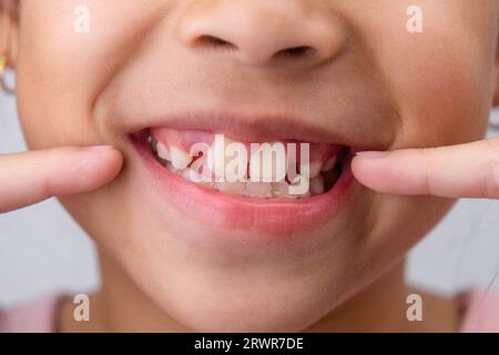 Gros plan de mignonne jeune fille souriant large, montrant l'espace vide avec la croissance des premières dents avant. Petite fille avec un grand sourire et des dents de lait manquantes. Denta Banque D'Images