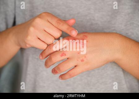 Mains du patient appliquant de la crème pommade sur l'eczéma. Banque D'Images