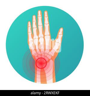 Localisation de douleur de cercle rouge dans la blessure de poignet de main humaine, squelette, articulations et vecteur osseux Illustration de Vecteur