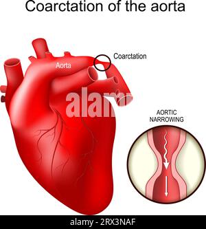 Les coarctations aortiques. Malformation cardiaque congénitale. Gros plan de la section transversale du rétrécissement aortique. Anomalies cardiovasculaires. Sténose de l'aorte. vect Illustration de Vecteur