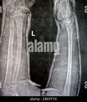 Radiographie simple de l'avant-bras droit (écrite par erreur à gauche sur le film) montrant une fracture de la partie inférieure du cubitus dans le plâtre pendant 4 semaines et a commencé à guérir Banque D'Images