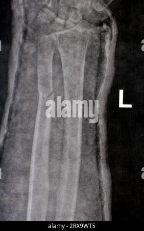 Radiographie simple de l'avant-bras droit (écrite par erreur à gauche sur le film) montrant une fracture de la partie inférieure du cubitus dans le plâtre pendant 4 semaines et a commencé à guérir Banque D'Images