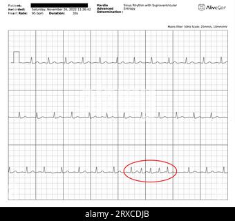 ECG / ECG graphique / graphique / graphique / tracé montrant un rythme sinusal normal (NSR) avec une rafale d'ectopie supraventriculaire (SVE) / contractions auriculaires prématurées (PACS) Banque D'Images