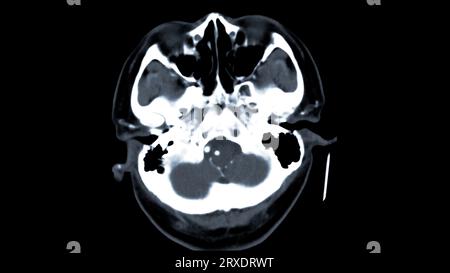 Scanner du cerveau avec le produit de contraste d'injection pour le diagnostic de tumeur cérébrale, les maladies d'AVC et les maladies vasculaires. Banque D'Images