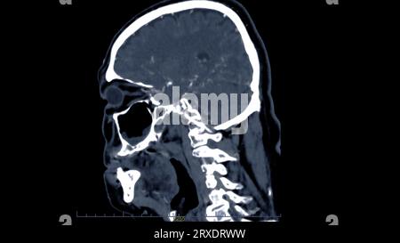 Scanner du cerveau avec le produit de contraste d'injection pour le diagnostic de tumeur cérébrale, les maladies d'AVC et les maladies vasculaires. Banque D'Images