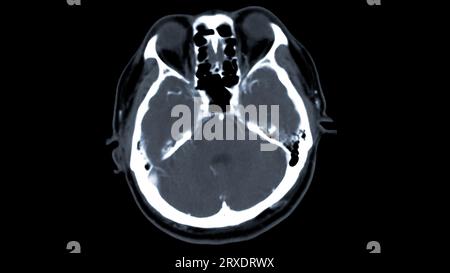 Scanner du cerveau avec le produit de contraste d'injection pour le diagnostic de tumeur cérébrale, les maladies d'AVC et les maladies vasculaires. Banque D'Images