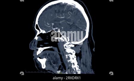 Scanner du cerveau avec le produit de contraste d'injection pour le diagnostic de tumeur cérébrale, les maladies d'AVC et les maladies vasculaires. Banque D'Images