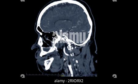 Scanner du cerveau avec le produit de contraste d'injection pour le diagnostic de tumeur cérébrale, les maladies d'AVC et les maladies vasculaires. Banque D'Images