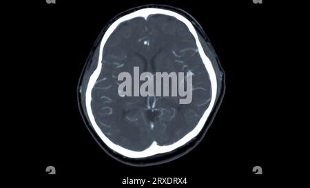 Scanner du cerveau avec le produit de contraste d'injection pour le diagnostic de tumeur cérébrale, les maladies d'AVC et les maladies vasculaires. Banque D'Images