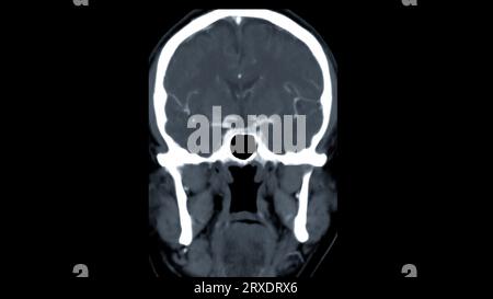 Scanner du cerveau avec le produit de contraste d'injection pour le diagnostic de tumeur cérébrale, les maladies d'AVC et les maladies vasculaires. Banque D'Images