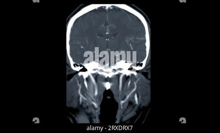 Scanner du cerveau avec le produit de contraste d'injection pour le diagnostic de tumeur cérébrale, les maladies d'AVC et les maladies vasculaires. Banque D'Images