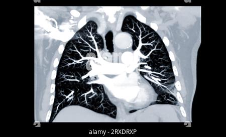 CTPA ou CTA artère pulmonaire pour diagnostic d'embolie pulmonaire (EP), de cancer du poumon et de covid-19. . Banque D'Images