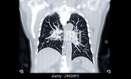 CTPA ou CTA artère pulmonaire pour diagnostic d'embolie pulmonaire (EP), de cancer du poumon et de covid-19. . Banque D'Images