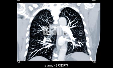 CTPA ou CTA artère pulmonaire pour diagnostic d'embolie pulmonaire (EP), de cancer du poumon et de covid-19. . Banque D'Images