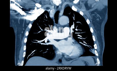 CTPA ou CTA artère pulmonaire pour diagnostic d'embolie pulmonaire (EP), de cancer du poumon et de covid-19. . Banque D'Images