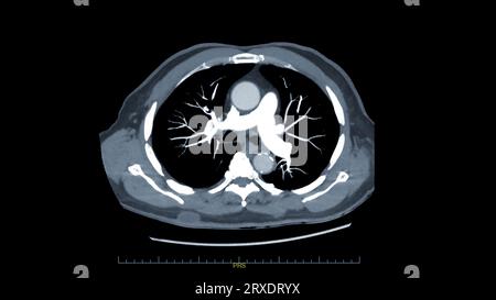 CTPA ou CTA artère pulmonaire pour diagnostic d'embolie pulmonaire (EP), de cancer du poumon et de covid-19. . Banque D'Images