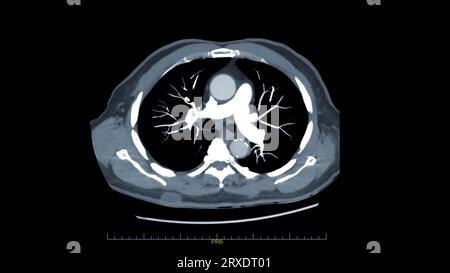 CTPA ou CTA artère pulmonaire pour diagnostic d'embolie pulmonaire (EP), de cancer du poumon et de covid-19. . Banque D'Images