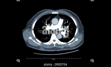 CTPA ou CTA artère pulmonaire pour diagnostic d'embolie pulmonaire (EP), de cancer du poumon et de covid-19. . Banque D'Images
