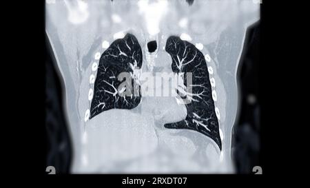 CTPA ou CTA artère pulmonaire pour diagnostic d'embolie pulmonaire (EP), de cancer du poumon et de covid-19. . Banque D'Images