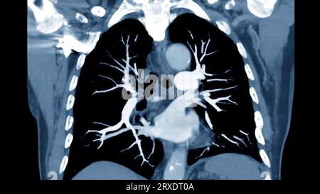 CTPA ou CTA artère pulmonaire pour diagnostic d'embolie pulmonaire (EP), de cancer du poumon et de covid-19. . Banque D'Images