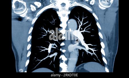 CTPA ou CTA artère pulmonaire pour diagnostic d'embolie pulmonaire (EP), de cancer du poumon et de covid-19. . Banque D'Images