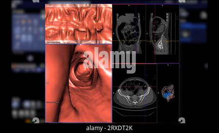 CT colonography compare les plans axial, sagittal, frontal 2D et 3D pour le dépistage du cancer colorectal. Pour les bilans de santé annuels à analyser Banque D'Images