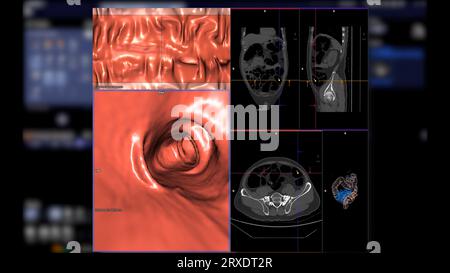 CT colonography compare les plans axial, sagittal, frontal 2D et 3D pour le dépistage du cancer colorectal. Pour les bilans de santé annuels à analyser Banque D'Images