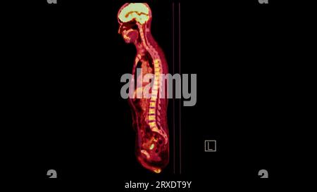 Image PET CT du plan sagittal du corps humain entier. Tomodensitométrie par émission de positons. Banque D'Images
