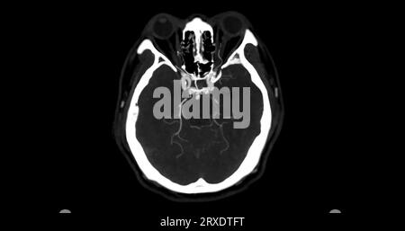Angiographie angiographique angiographique angiographique TDM de la vue mip axiale du cerveau montrant l'artère cérébrale. Banque D'Images