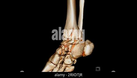 Scanner CT articulation de la cheville ou tomodensitométrie de l'articulation de la cheville image de rendu 3D . Banque D'Images