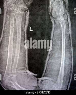 Radiographie simple de l'avant-bras droit (écrite par erreur à gauche sur le film) montrant une fracture de la partie inférieure du cubitus dans le plâtre pendant 4 semaines et a commencé à guérir Banque D'Images