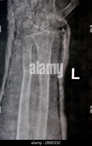 Radiographie simple de l'avant-bras droit (écrite par erreur à gauche sur le film) montrant une fracture de la partie inférieure du cubitus dans le plâtre pendant 4 semaines et a commencé à guérir Banque D'Images